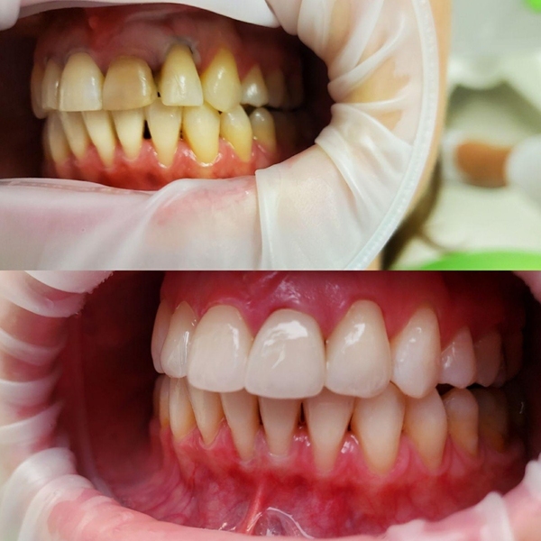 Estētiskā zobu restaurācija
