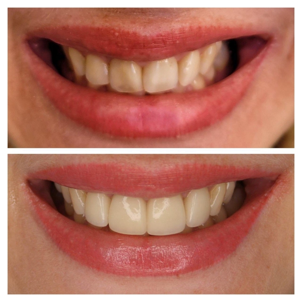 Estētiskā zobu restaurācija