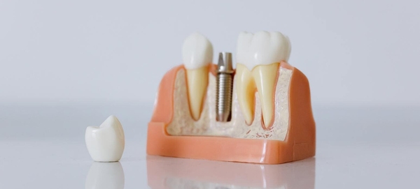 Kas pacientam jāzina pirms zobu protezēšanas
