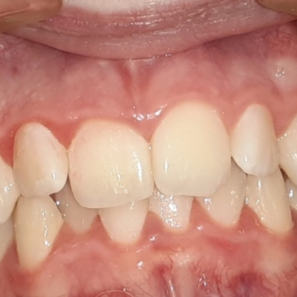 Orthodontics with braces