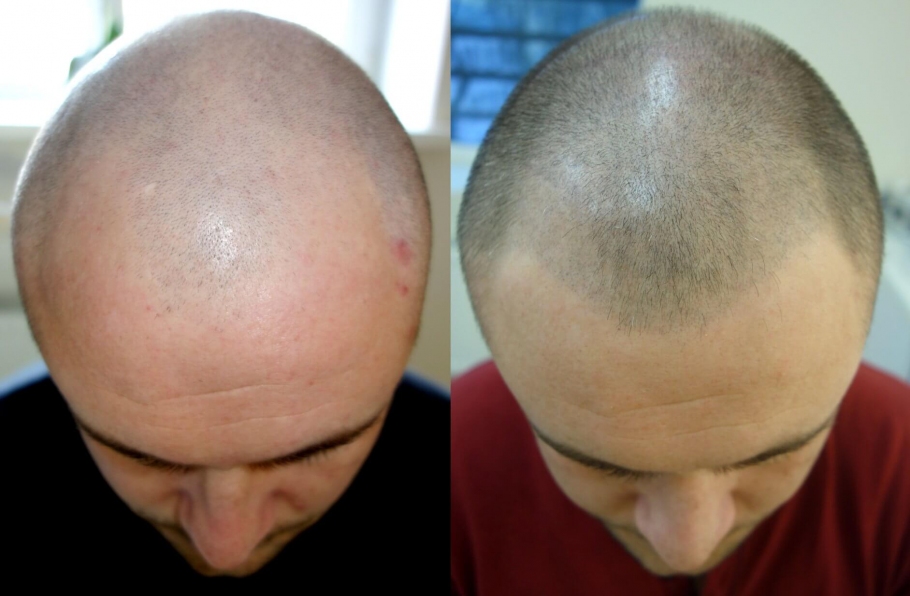 The scalp micropigmentation (tricopigmentation)