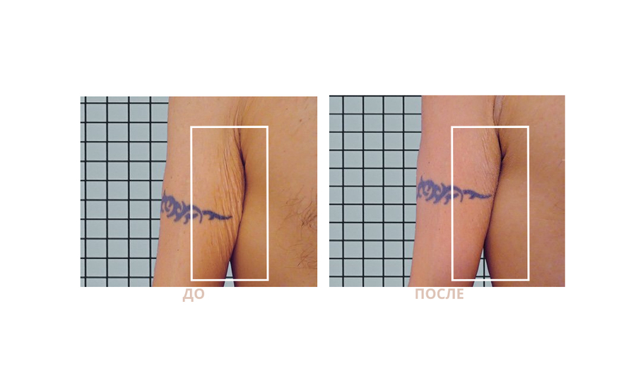 Аппаратные процедуры для тела и лица ICOONE лазер