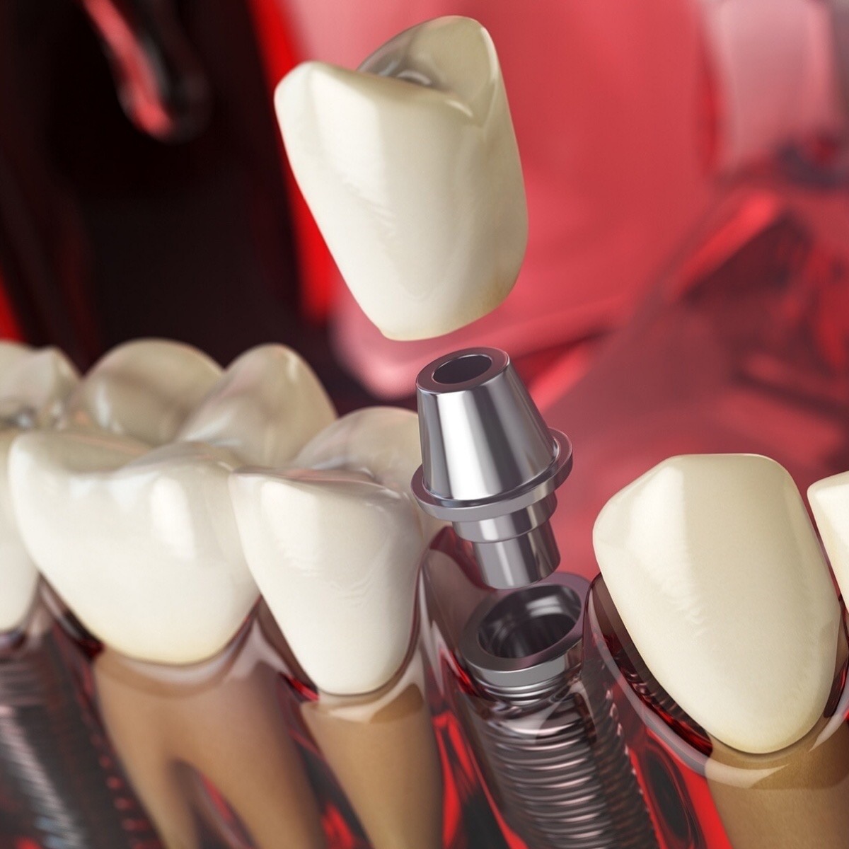 Advantages of Dental Implants