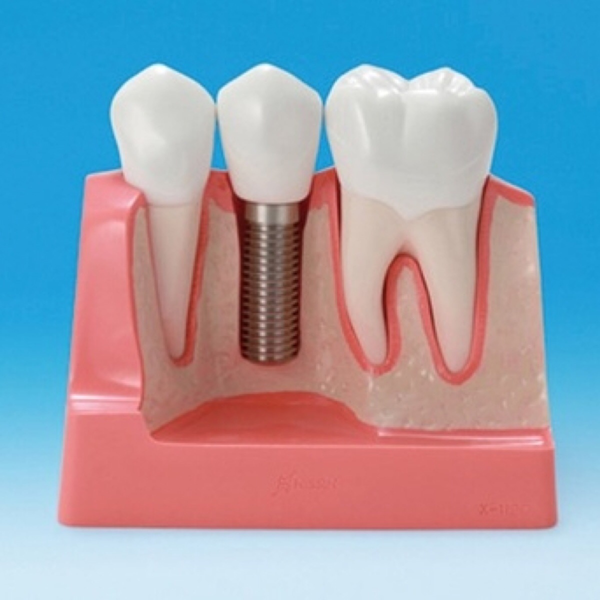 Модель импланта. Стоматологические импланты.