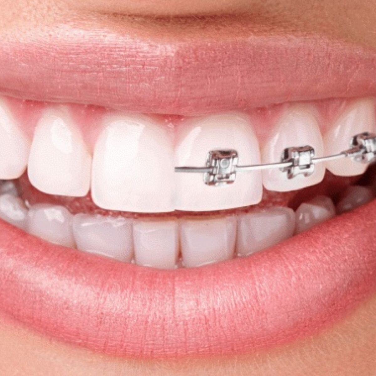 Рекомендуемый возраст установки брекетов детям