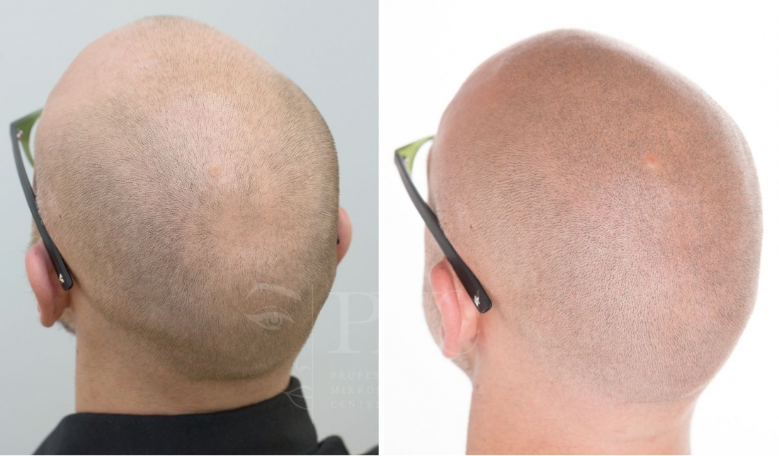 Трихопигментация помогает мужчинам вернуть уверенность!