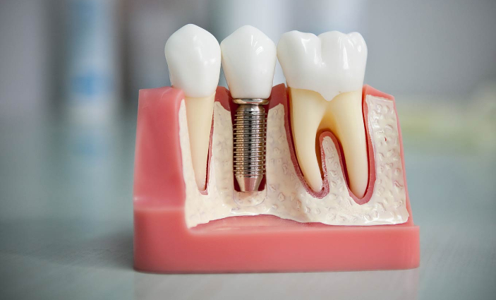 Протезирование зубов при эстетической реставрации