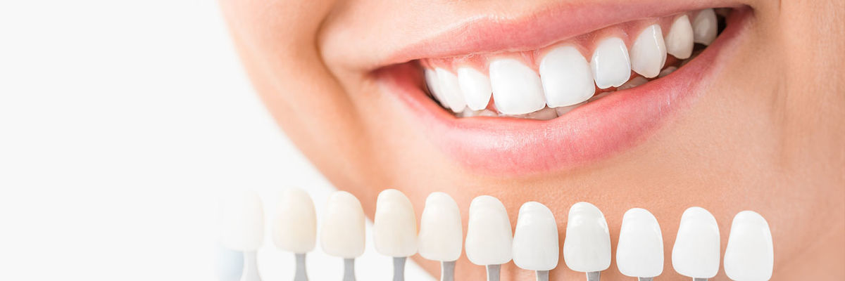 Читайте новую публикацию о ВИНИРАХ на нашем сайте!