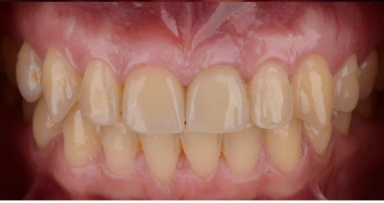 Viens im – 1 after