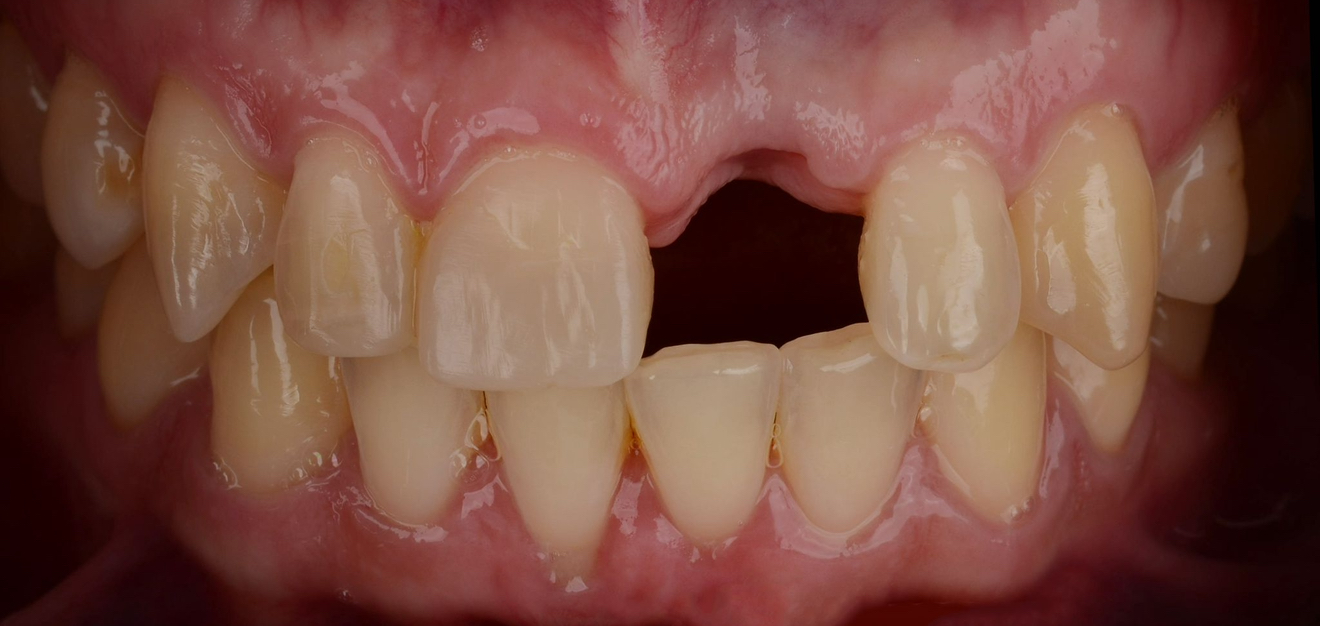 Viens im – 1 before