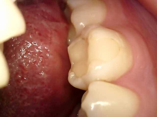 Terapija Arina before