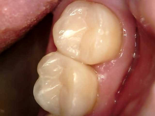 Arina 2 after